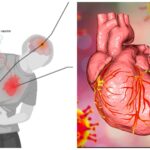 46 million adults reveals COVID-19 vaccinations significantly reduced the risk of heart attacks and strokes